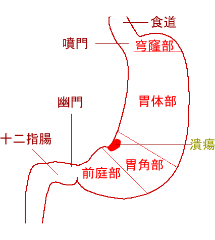 胃潰瘍